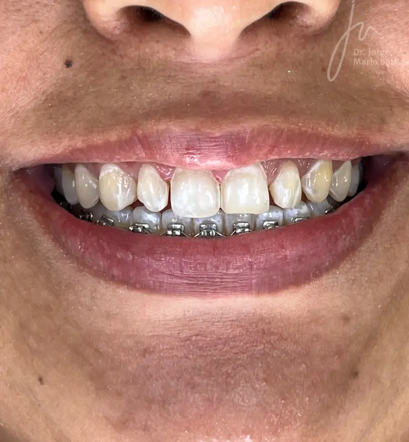 35