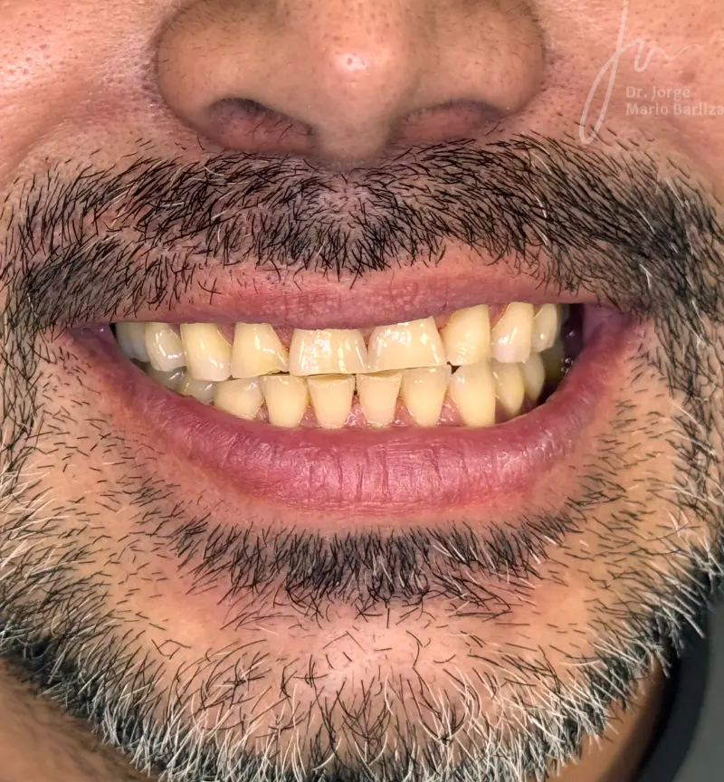 37